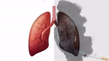 肺癌一查就是晚期？其实双肺早早给了暗示，只是大多数人忽略了